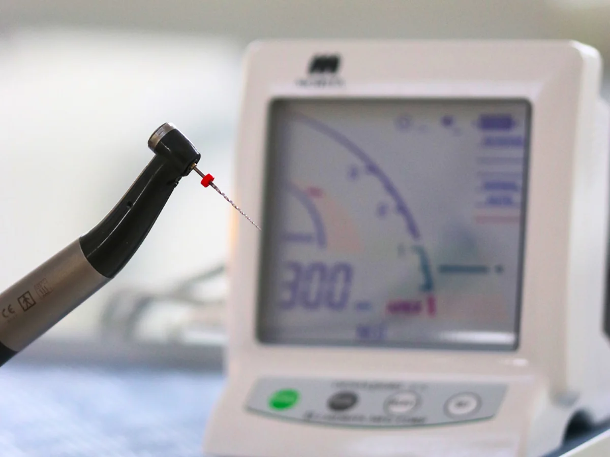 Gépi műszeres gyökérkezelés